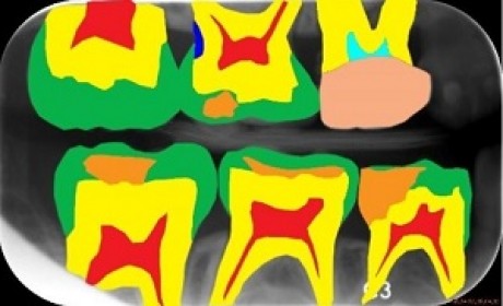 牙齿Bitewing Radiology数据集