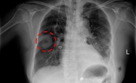 胸部NIH Chest X-ray数据集